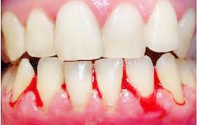 Photo of bleeding gums
